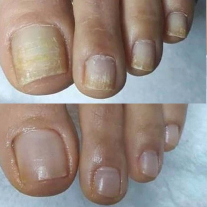 Yellow toenail comparison